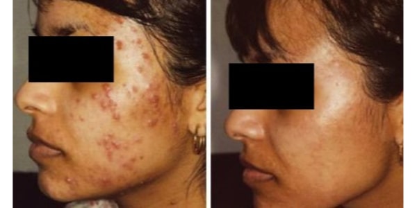 Before After Photos