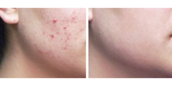 Before After Photos
