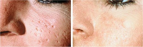 acne scar before and after in chennai