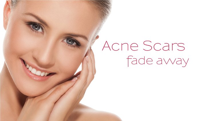 acne scar removal treatment in chennai