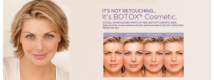 Botox injections for wrinkle reduction